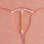 Es handelt sich um ein Symbolbild das zeigt wie eine Kupfer oder Goldspirale in der Gebärmutterhöhle zu liegen kommt. Gut erkennbar sind auch die Flügelchen die an den Tubenwinkeln der Fixierung dienen.