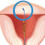 Der Zeit wird exemplarisch die Fixierung (Verankerung) der Gynefix Kupferkette. Es soll demonstriert werden dass sich die Fixierung optimal in der Mitte des Fundus befindet.